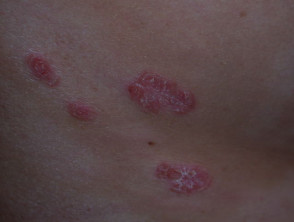 Imagen mostrando el aspecto brillante y elevado de las placas de psoriasis.