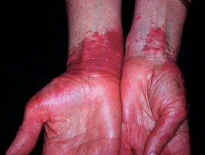 Allergische contactdermatitis van de handen. 