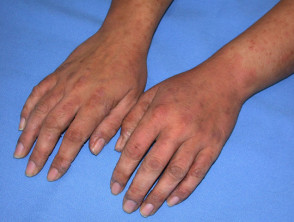 Dermatitis alérgica de contacto de las manos.