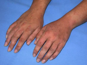 Allergische contactdermatitis van de handen.