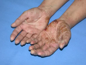 Allergische contactdermatitis van de handen.