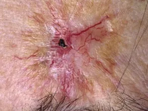 Carcinoma a cellule basali che colpisce il viso.