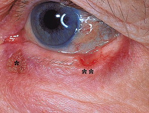 Basalzellkarzinom, das das Augenlid betrifft 