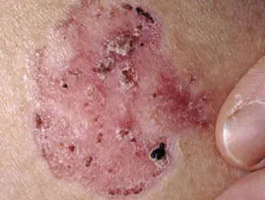 Carcinoma a cellule basali che colpisce il viso.