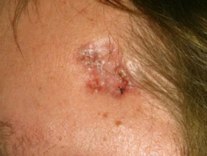 Carcinoma de células basales que afecta a la cara.