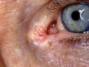 Basaalcelcarcinoom dat het ooglid aantast. 