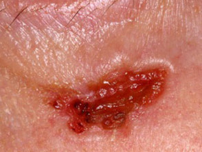 Carcinoma de células basales que afecta a la cara