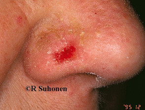 Carcinoma de células basales que afecta a la nariz.