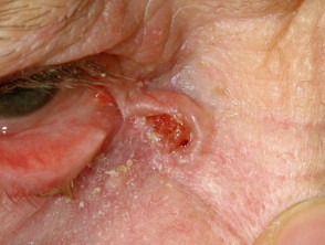 Carcinoma basocellulare che colpisce la palpebra 