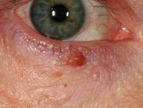 Basalzellkarzinom, das das Augenlid betrifft 
