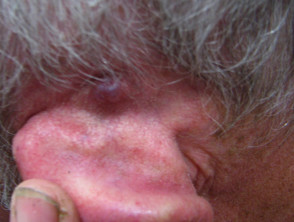 Carcinoma de células basales que afecta al oído