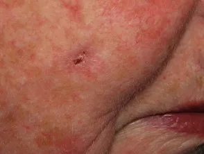 Carcinoma a cellule basali che colpisce il viso