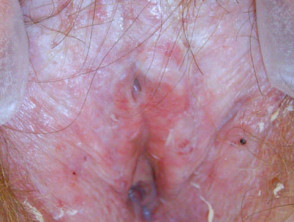Liquen escleroso vulvar 