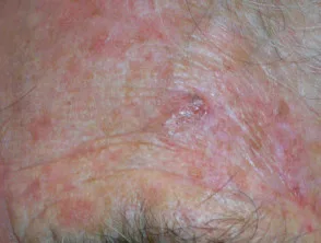 Carcinoma a cellule basali che colpisce il viso