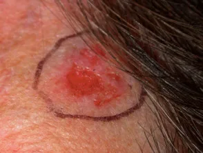 Carcinoma a cellule basali che colpisce il viso.