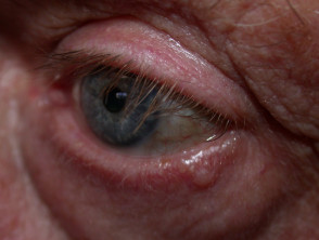 Basalzellkarzinom, das das Augenlid betrifft. 
