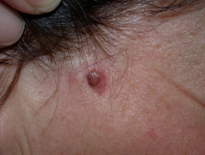 Carcinoma de células basales que afecta a la cara