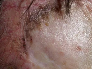 Carcinoma a cellule basali che colpisce il viso.