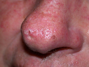 Carcinoma de células basales que afecta a la nariz.
