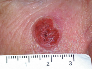 Carcinoma de células basales que afecta a la cara.