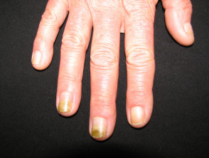 Candida albicans que afecta las uñas
