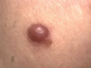 Melanoma amelanotico nodulare