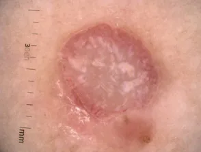 Melanoma amelanotico: dermatoscopia