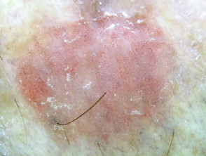 Vista dermatoscópica de SCC in situ