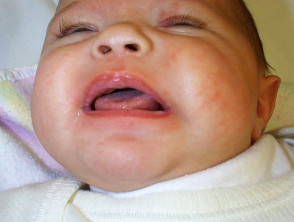 Candidosi orale infantile