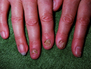 Candida albicans que afecta las uñas