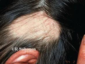 Alopecia areata