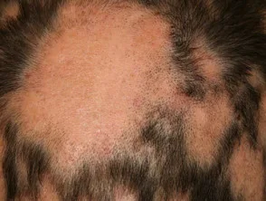 Alopecia areata