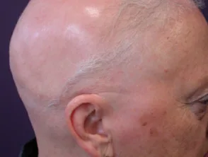 Alopecia areata