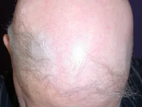 Alopecia areata