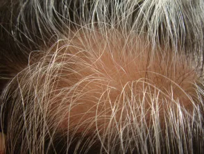 Alopecia areata