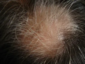 Alopecia areata