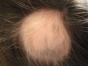 Alopecia areata