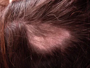 Alopecia areata