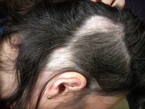 Alopecia areata