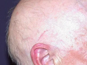 Alopecia areata