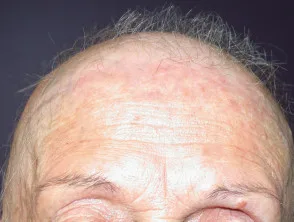 Alopecia areata