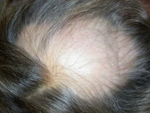 Alopecia areata