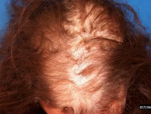 Alopecia areata