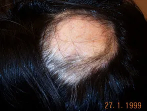 Alopecia areata