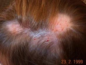 Alopecia areata