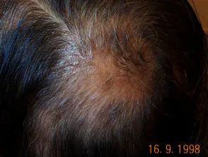 Alopecia areata