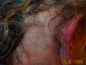 Alopecia areata