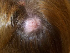 Alopecia areata