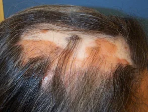 Alopecia areata