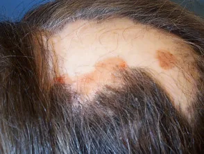 Alopecia areata